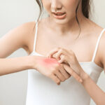 Can eczema cream soothe itchy skin